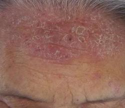 ����ţƤѢʱ����Щҩ���ܳ�