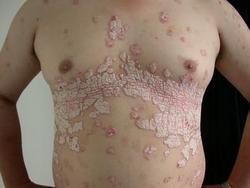 ʲô���Ĳ���ᵼ��ţƤѢ